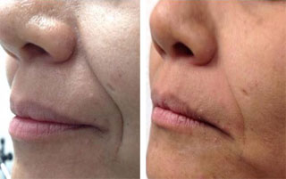 Endolifting 4D® twarzy laserem Fotona 4D