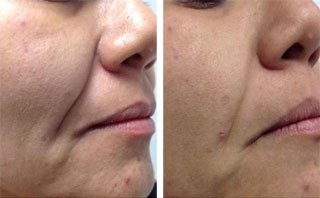 Endolifting 4D® twarzy laserem Fotona 4D