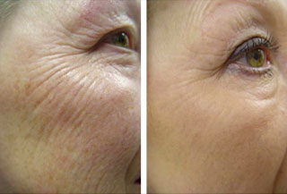 Endolifting 4D® twarzy laserem Fotona 4D