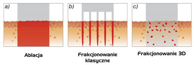 Frakcjonowanie 3D