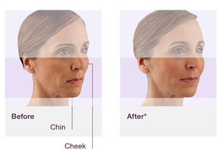 Preparat JUVÉDERM® VOLUMA® - efekt działania