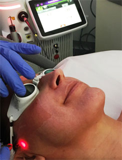 Peeling laserowy Fotona
