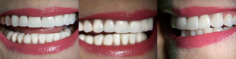 The final result of the dental treatment Madame Małgorzata