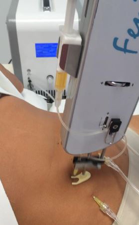 Mezoterapia z karboksyterapią